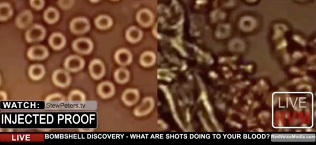 COVID Vax Contains Graphine Oxide confirmed, thickening of blood, side by side microscope images.
